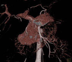 Multiple Islet Cell Tumors in Pancreatic Head - CTisus CT Scan