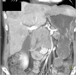 Peripancreatic Nodes and Liver Metastases - CTisus CT Scan