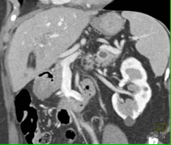 2cm Cystic Islet Cell Tumor in Tail of Pancreas - CTisus CT Scan