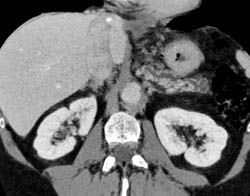 Dilated Pancreatic Duct - CTisus CT Scan