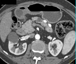 Intraductal Papillary Mucinous Neoplasm (IPMN) - CTisus CT Scan