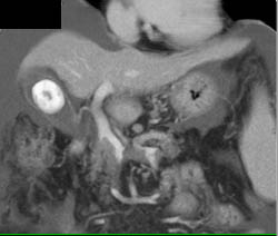 Thrombus in PV/SMV Junction - CTisus CT Scan