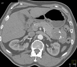 Mucinous Cystadenoma of the Tail of the Pancreas - CTisus CT Scan