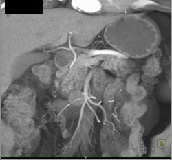 Pancreatic Cancer Encases Proximal Branch Off the SMA - CTisus CT Scan