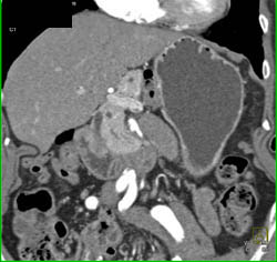 Pancreatic Cancer - CTisus CT Scan