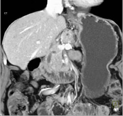 Pancreatic Cancer - CTisus CT Scan