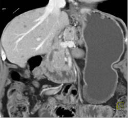 Pancreatic Cancer - CTisus CT Scan