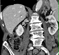 Cystic Lesions in the Pancreatic Head - CTisus CT Scan