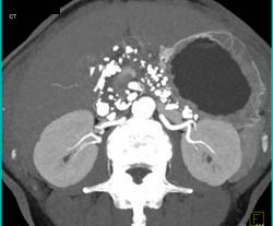 Chronic Pancreatitis - CTisus CT Scan