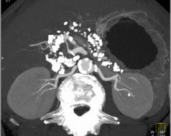 Chronic Pancreatitis - CTisus CT Scan