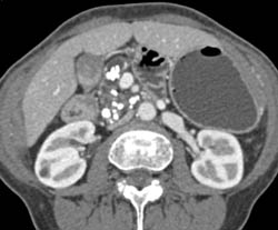 Chronic Pancreatitis - CTisus CT Scan