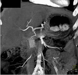 Pancreatic Cancer Encases the PV/SMV Confluence With Collaterals - CTisus CT Scan