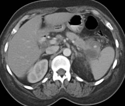 Pseudoaneurysm in Pseudocyst in Tail of Pancreas - CTisus CT Scan