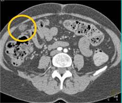 Pancreatic Cancer in Tail of Pancreas With Implants on the Omentum and Encased Splenic Artery - CTisus CT Scan