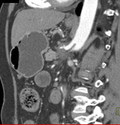 Encased Celiac Axis - CTisus CT Scan