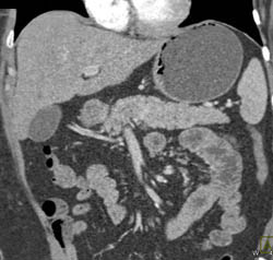 Islet Cell Tumor in Body of Pancreas - CTisus CT Scan