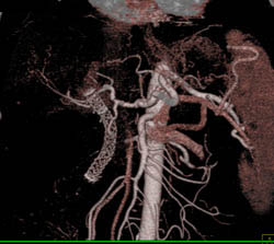 Encased Hepatic Stent in Artery and Common Bile Duct (CBD) in Patient With Pancreatic Cancer - CTisus CT Scan