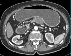 Pancreatic Cancer Obstructs the Fourth Portion of the Duodenum - CTisus CT Scan