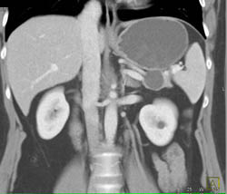 Intraductal Papillary Mucinous Neoplasm (IPMN) - CTisus CT Scan