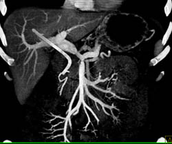 Encased PV/SMV Confluence - CTisus CT Scan