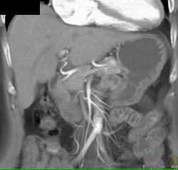 Multiple Vascular Metastases to the Pancreas and Liver From Renal Cell Carcinoma - CTisus CT Scan