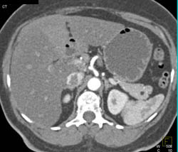 Small Lipoma in Tail of Pancreas - CTisus CT Scan