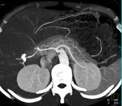 Normal MIP of Pancreas - CTisus CT Scan