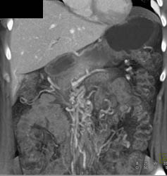 Cavernous Transformation of the Portal Vein- Cavernous Transformation of the Portal Vein (CTPV)- With Collaterals Around the Pancreas - CTisus CT Scan