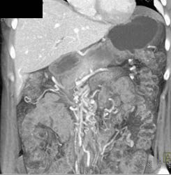 Collaterals Nicely Shown Around the SMA - CTisus CT Scan