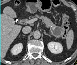 Intraductal Papillary Mucinous Neoplasm (IPMN) - CTisus CT Scan