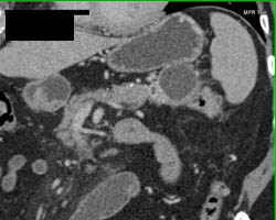 Intraductal Papillary Mucinous Neoplasm (IPMN) - CTisus CT Scan