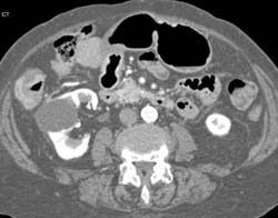 Carcinomatosis - CTisus CT Scan