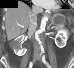 Carcinomatosis - CTisus CT Scan