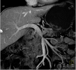 Pancreatic Cancer Encases the PV/SMV - CTisus CT Scan