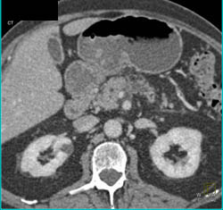 Pancreatic Cancer Encases the PV/SMV - CTisus CT Scan