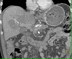 Tumor Invades the Portal Vein With Collaterals and Perfusion Changes in the Liver - CTisus CT Scan