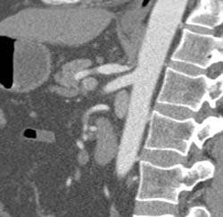 Median arcuate ligament syndrome что это