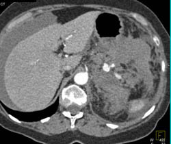 Splenic Artery Pseudo-aneurysm Due to Pancreatitis - CTisus CT Scan