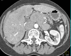 Pancreatic Cancer With Liver Metastases With Extensive Adenopathy - CTisus CT Scan