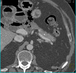 S/P Whipple Procedure - CTisus CT Scan