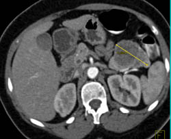 Cystadenocarcinoma of the Pancreatic Tail - CTisus CT Scan