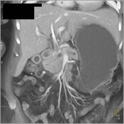 Pancreatic Cancer Encases the SMV/PV - CTisus CT Scan