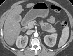 Intraductal Papillary Mucinous Neoplasm (IPMN) - CTisus CT Scan