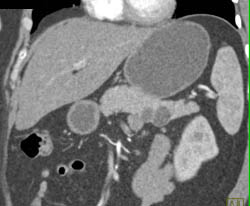 Intraductal Papillary Mucinous Neoplasm (IPMN) - CTisus CT Scan