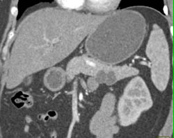 Intraductal Papillary Mucinous Neoplasm (IPMN) - CTisus CT Scan