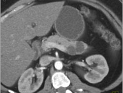 Intraductal Papillary Mucinous Neoplasm (IPMN) - CTisus CT Scan