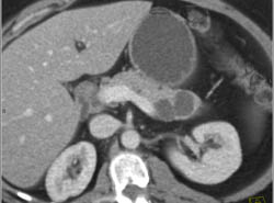 Intraductal Papillary Mucinous Neoplasm (IPMN) - CTisus CT Scan