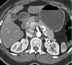 Intraductal Papillary Mucinous Neoplasm (IPMN) With Septations - CTisus CT Scan