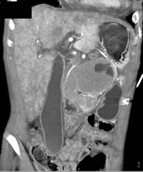 Lymphoma Involving the Right Atrium and the Pancreas - CTisus CT Scan