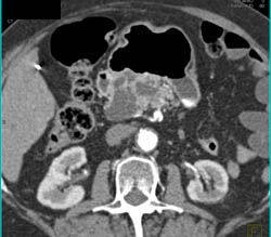 Intraductal Papillary Mucinous Neoplasm (IPMN) - CTisus CT Scan